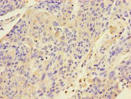 Immunohistochemistry of paraffin-embedded human cervical cancer using CSB-PA012556LA01HU at dilution of 1:100