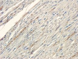 IHC-P staining of human endometrial cancer tissue using anti-Collagen III (2.5 ug/ml)