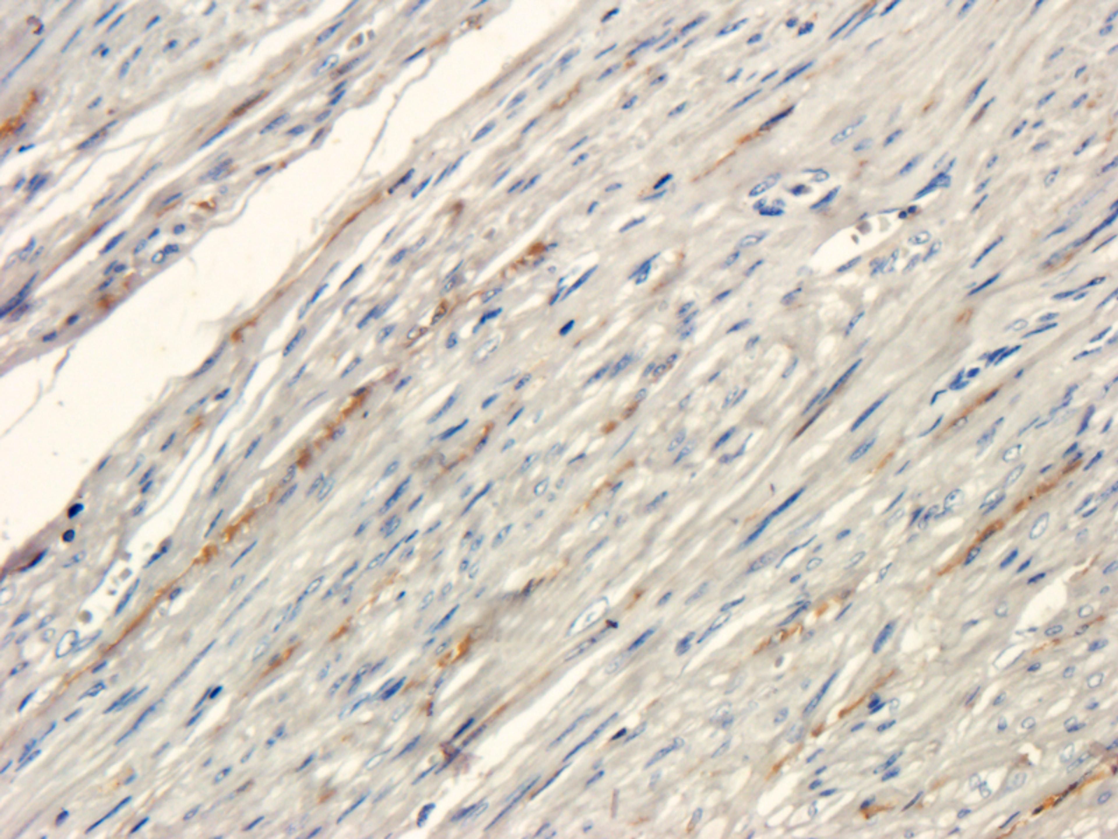 IHC-P staining of human endometrial cancer tissue using anti-Collagen III (2.5 ug/ml)