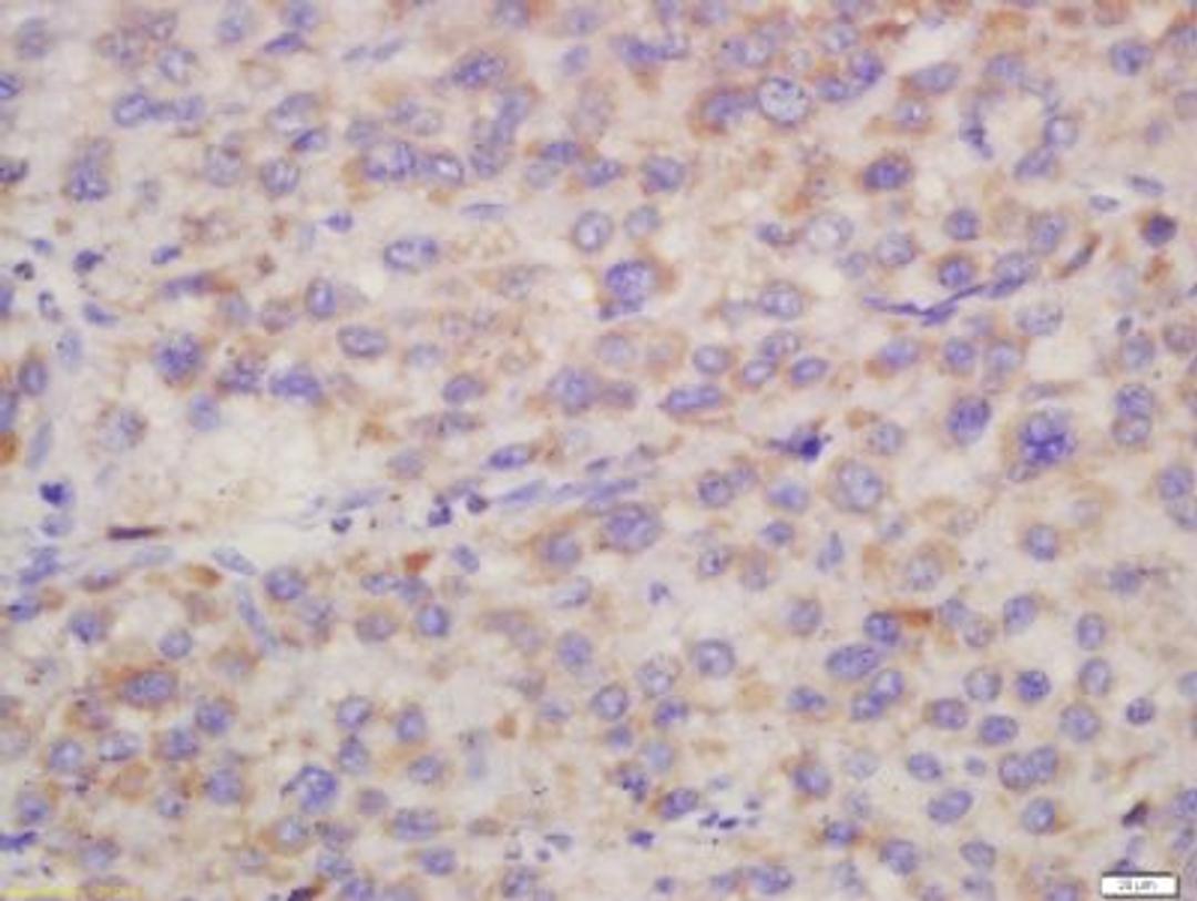 Immunohistochemical staining of human liver carcinoma tissue using Hepsin antibody.