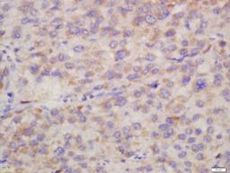 Immunohistochemical staining of human liver carcinoma tissue using Hepsin antibody.