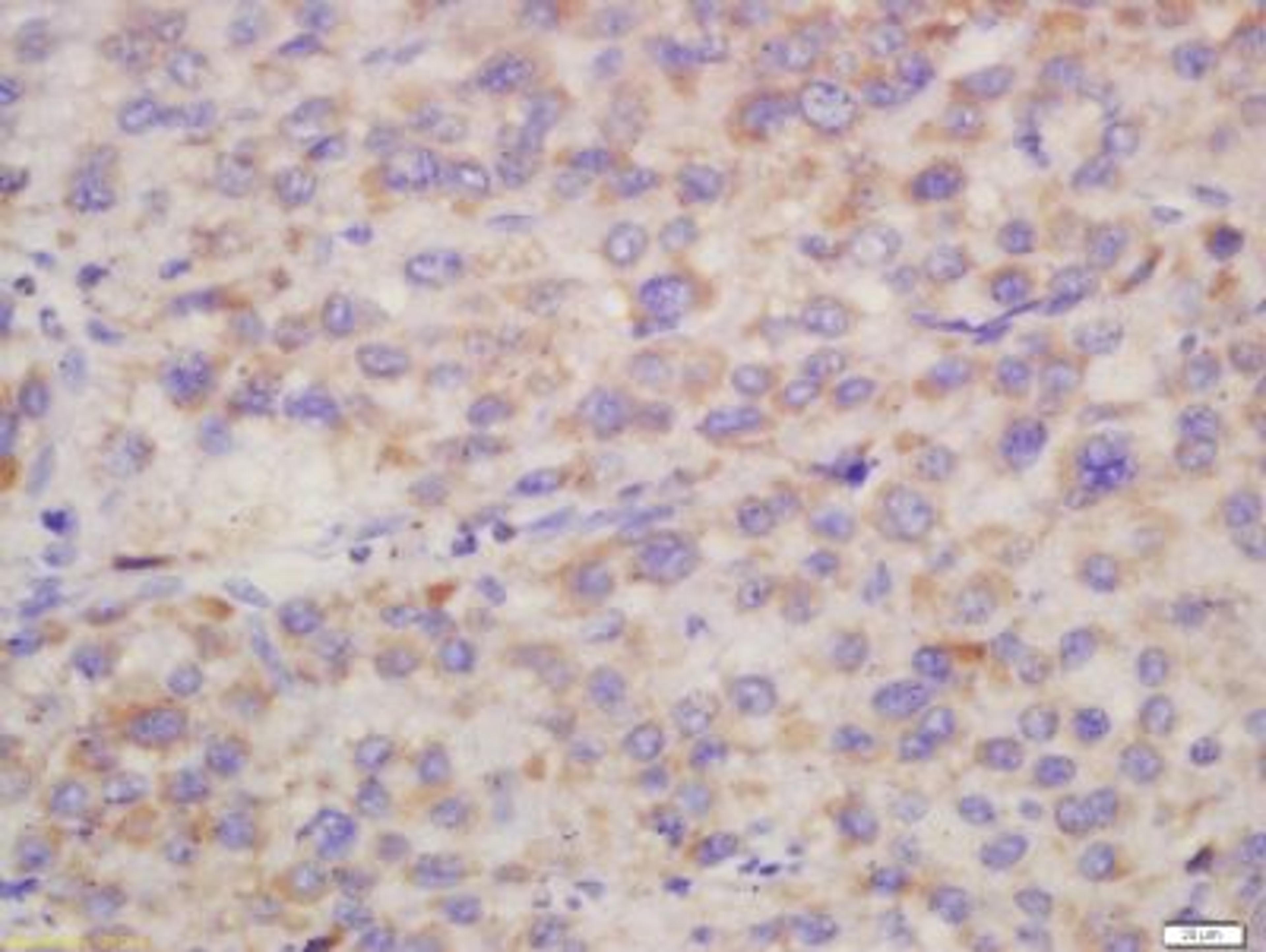 Immunohistochemical staining of human liver carcinoma tissue using Hepsin antibody.