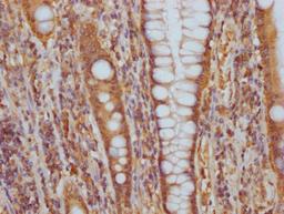 IHC image of CSB-RA548303A0HU diluted at 1:100 and staining in paraffin-embedded human colon cancer performed on a Leica BondTM system. After dewaxing and hydration, antigen retrieval was mediated by high pressure in a citrate buffer (pH 6.0). Section was blocked with 10% normal goat serum 30min at RT. Then primary antibody (1% BSA) was incubated at 4℃ overnight. The primary is detected by a Goat anti-rabbit IgG polymer labeled by HRP and visualized using 0.05% DAB.