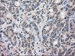 Immunohistochemistry-Paraffin: ERK2 Antibody (6E5) [NBP1-47842] - Staining of paraffin-embedded Adenocarcinoma of colon tissue using anti-ERK2 mouse monoclonal antibody.