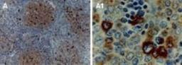 Immunohistochemistry-Paraffin: TRAF-1 Antibody [NB100-56170] -  Formalin-fixed, paraffin-embedded human lymphoma tissue section stained for TRAF-1 expression using NB100-56170 at 1:2000. Hematoxylin-eosin counterstain.  A1 is a higher magnification of A.