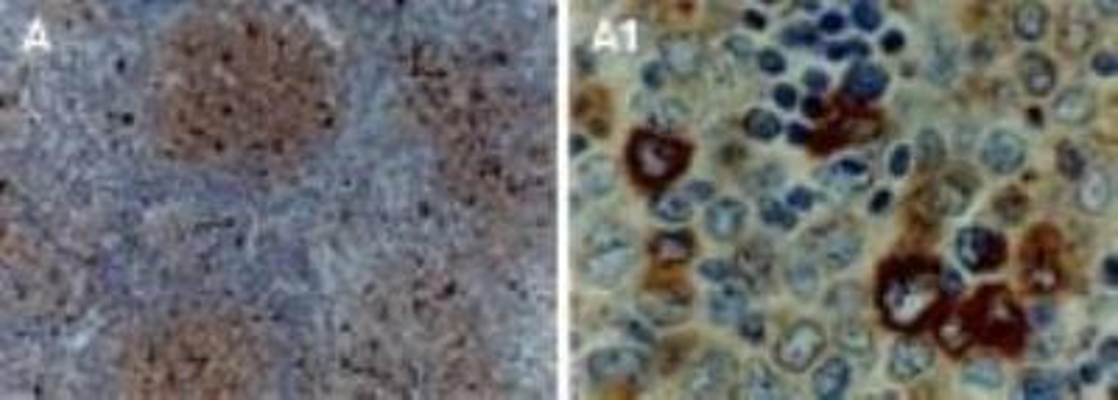 Immunohistochemistry-Paraffin: TRAF-1 Antibody [NB100-56170] -  Formalin-fixed, paraffin-embedded human lymphoma tissue section stained for TRAF-1 expression using NB100-56170 at 1:2000. Hematoxylin-eosin counterstain.  A1 is a higher magnification of A.