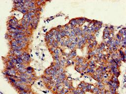 Immunohistochemistry of paraffin-embedded human colon cancer using CSB-PA009476LA01HU at dilution of 1:100
