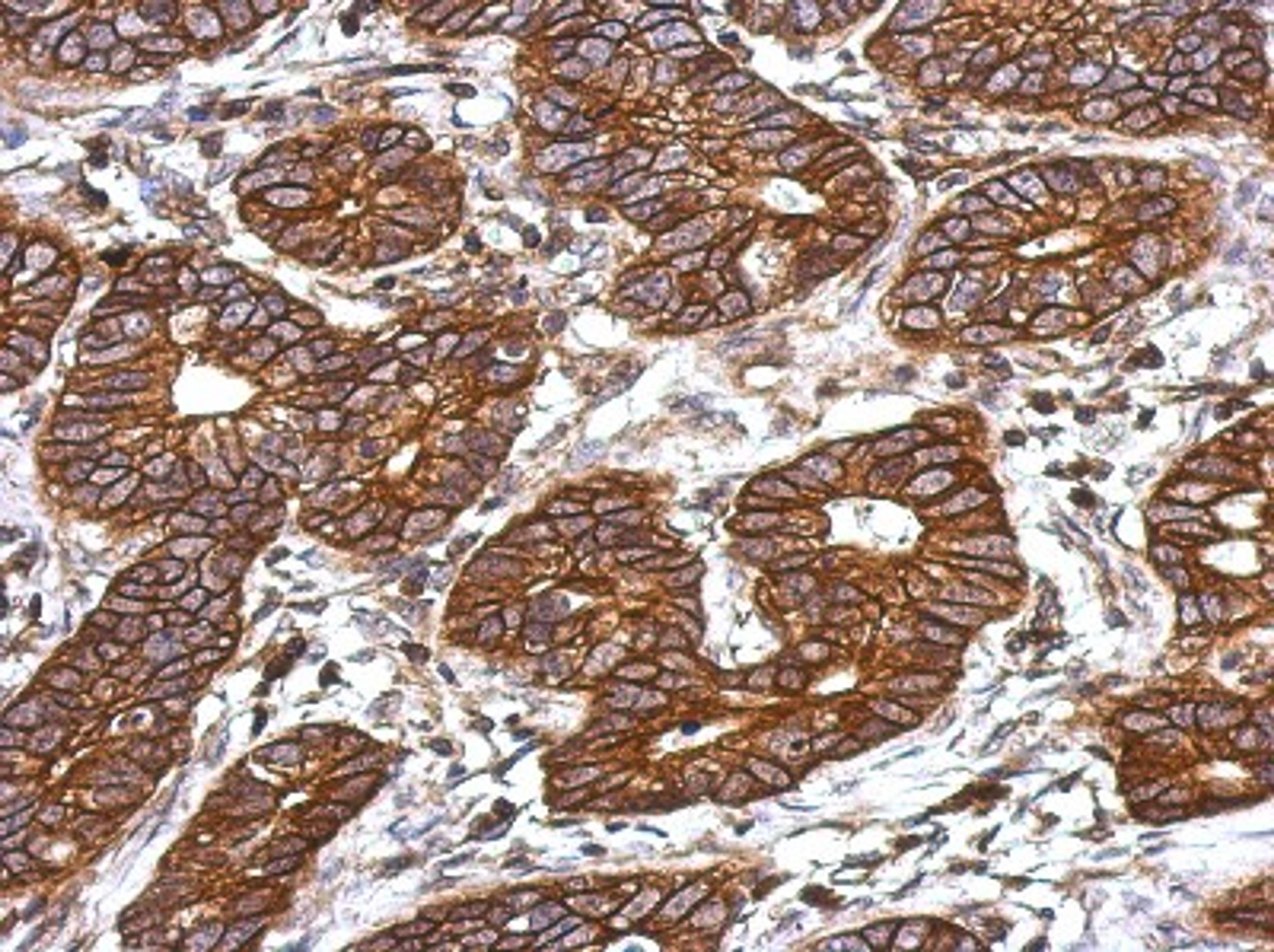 Immunohistochemistry-Paraffin: C3a receptor 1 Antibody [NBP2-15649] - Immunohistochemical analysis of paraffin-embedded Colon ca, using antibody at 1:500 dilution.