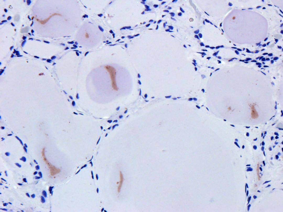 Immunohistochemical staining of human thyroid carcinoma tissue using Snail antibody (dilution of primary antibody - 1:200)