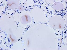 Immunohistochemical staining of human thyroid carcinoma tissue using Snail antibody (dilution of primary antibody - 1:200)