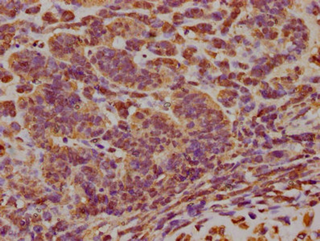IHC image of CSB-PA007512LA01HU diluted at 1:300 and staining in paraffin-embedded human ovarian cancer performed on a Leica BondTM system. After dewaxing and hydration, antigen retrieval was mediated by high pressure in a citrate buffer (pH 6.0). Section was blocked with 10% normal goat serum 30min at RT. Then primary antibody (1% BSA) was incubated at 4°C overnight. The primary is detected by a biotinylated secondary antibody and visualized using an HRP conjugated SP system.