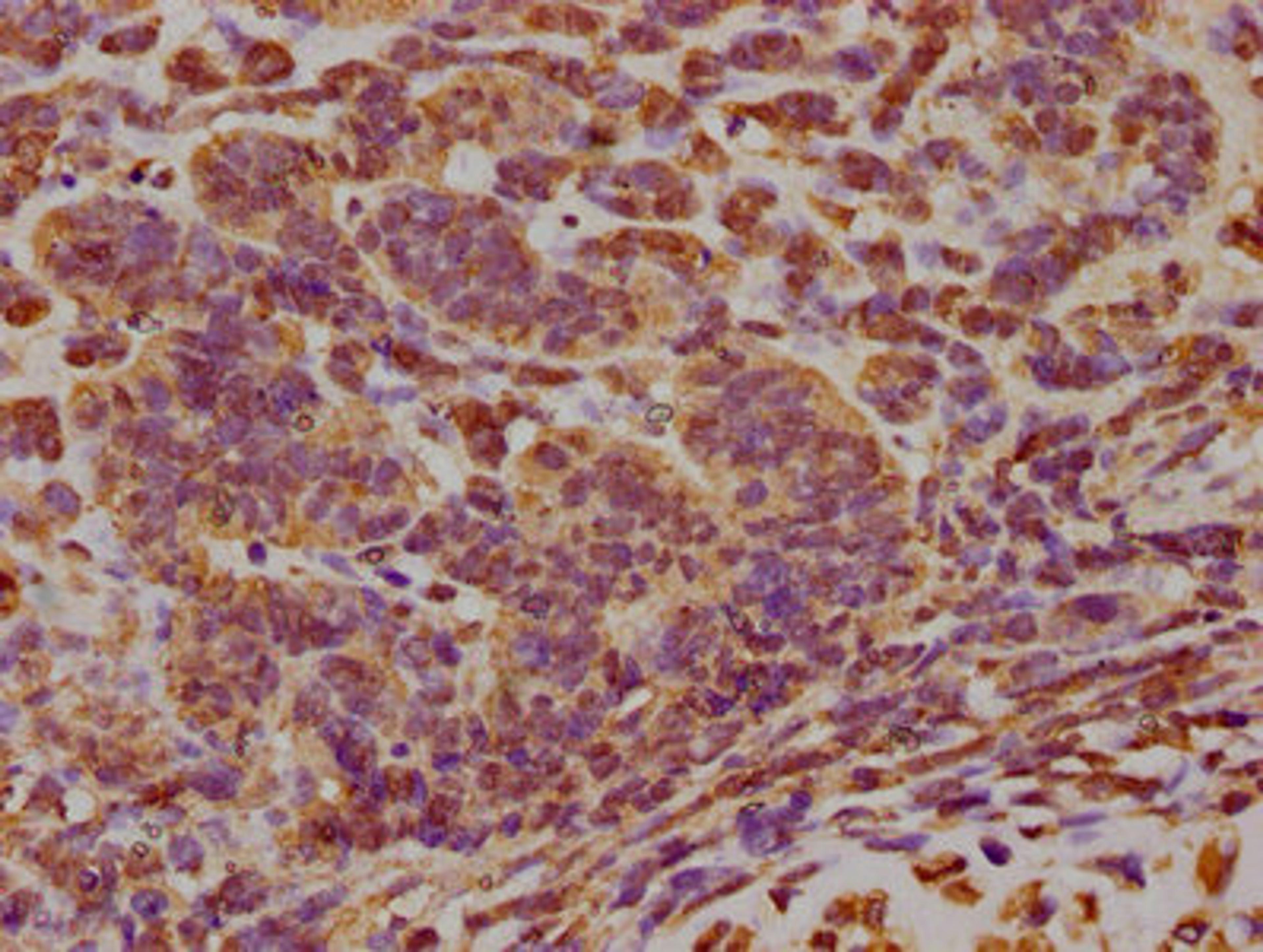 IHC image of CSB-PA007512LA01HU diluted at 1:300 and staining in paraffin-embedded human ovarian cancer performed on a Leica BondTM system. After dewaxing and hydration, antigen retrieval was mediated by high pressure in a citrate buffer (pH 6.0). Section was blocked with 10% normal goat serum 30min at RT. Then primary antibody (1% BSA) was incubated at 4°C overnight. The primary is detected by a biotinylated secondary antibody and visualized using an HRP conjugated SP system.