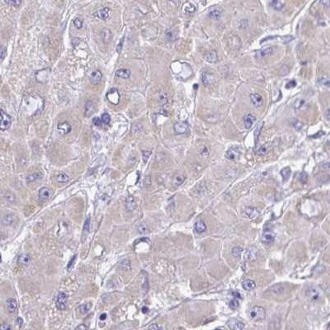 Immunohistochemistry: MPZL2 Antibody [NBP2-31836] - liver cancer