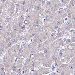 Immunohistochemistry: MPZL2 Antibody [NBP2-31836] - liver cancer