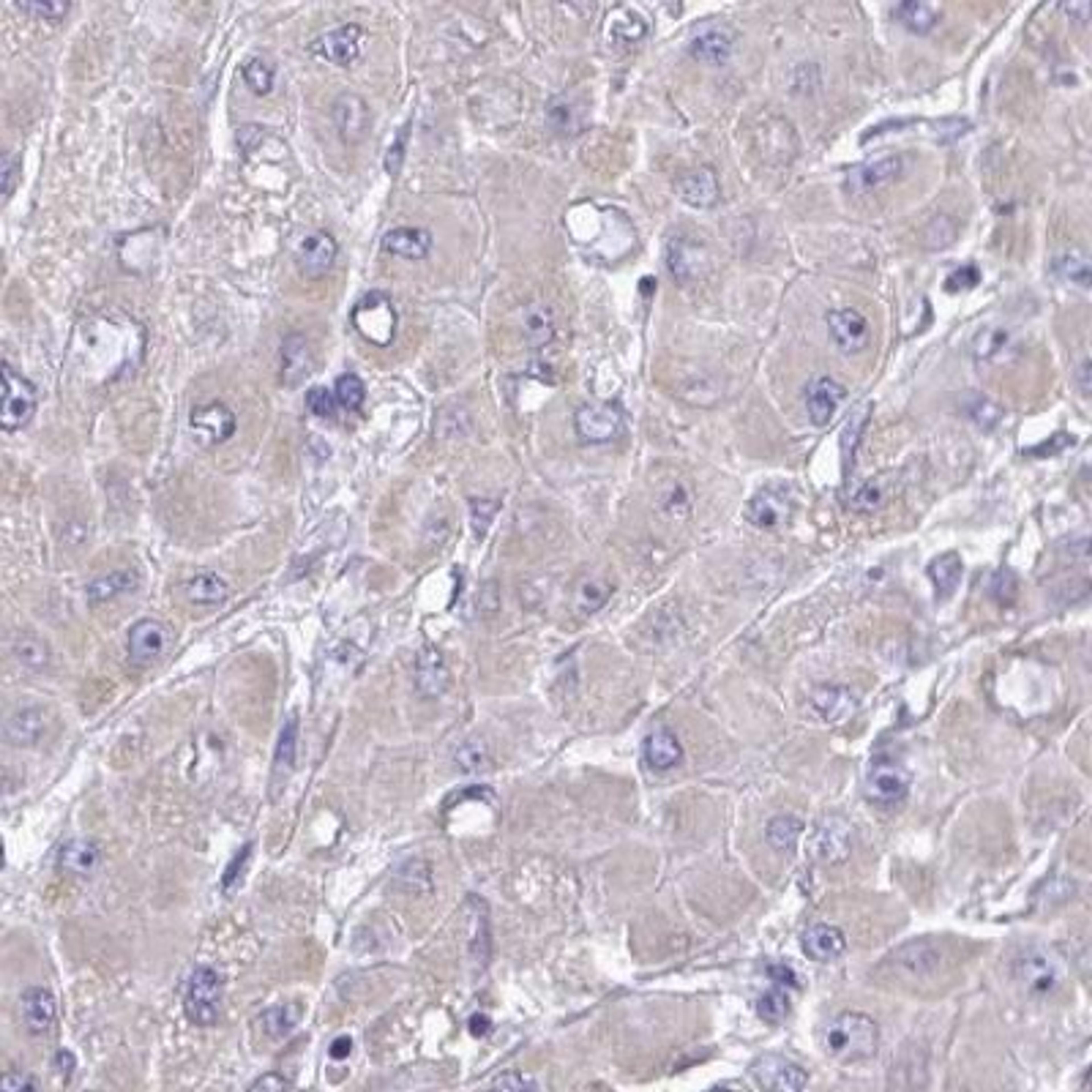 Immunohistochemistry: MPZL2 Antibody [NBP2-31836] - liver cancer