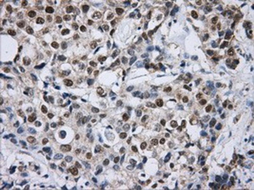 Immunohistochemistry-Paraffin: DCXR Antibody (7D11) [NBP2-02192] - Staining of paraffin-embedded Adenocarcinoma of breast tissue using anti-DCXR mouse monoclonal antibody.