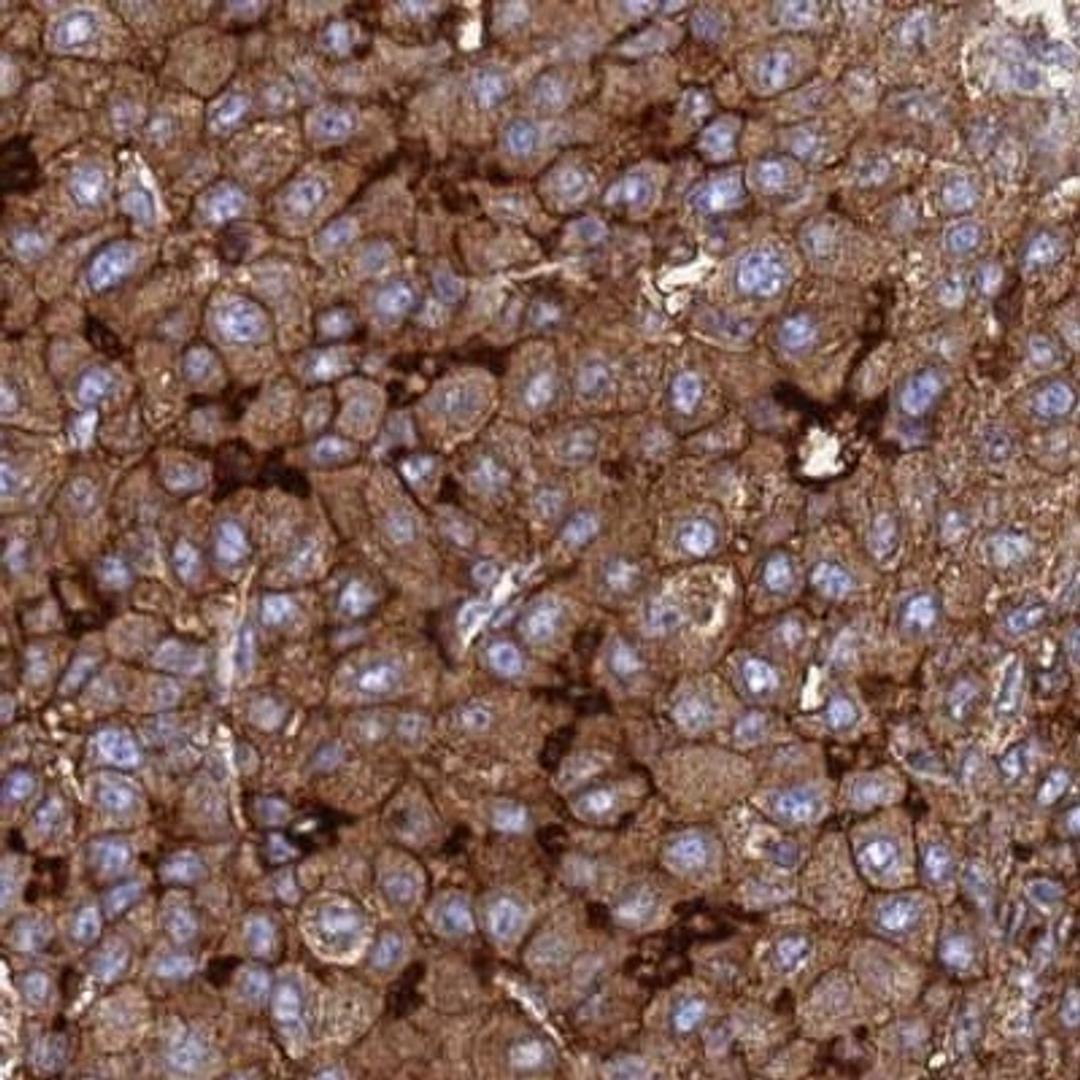 Immunohistochemistry: TM4SF4 Antibody [NBP2-33464] - liver cancer