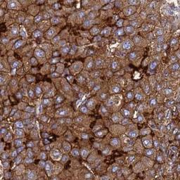 Immunohistochemistry: TM4SF4 Antibody [NBP2-33464] - liver cancer