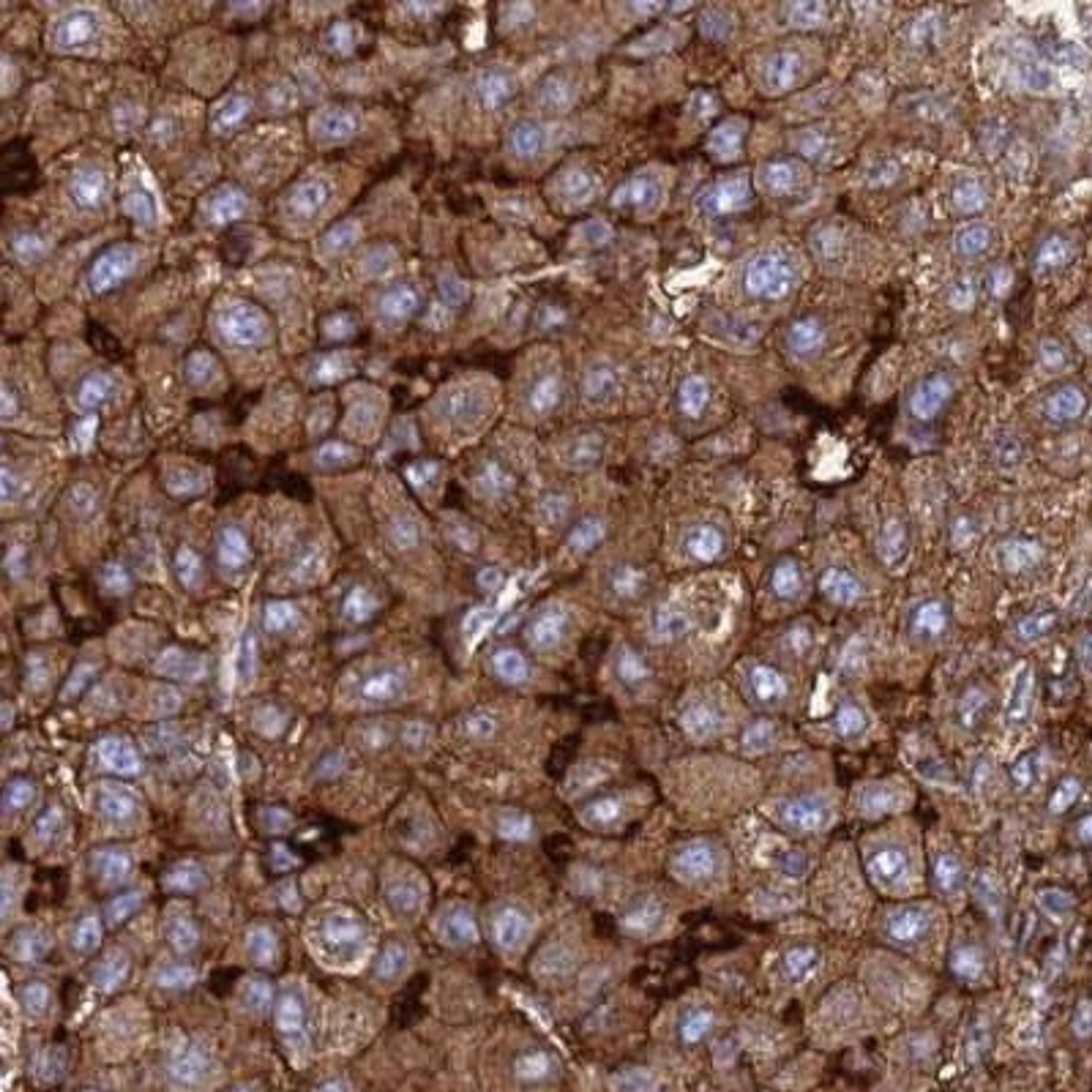 Immunohistochemistry: TM4SF4 Antibody [NBP2-33464] - liver cancer