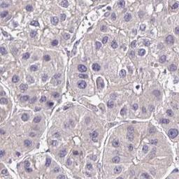 Immunohistochemistry: PRIMA1 Antibody [NBP2-32508] - liver cancer