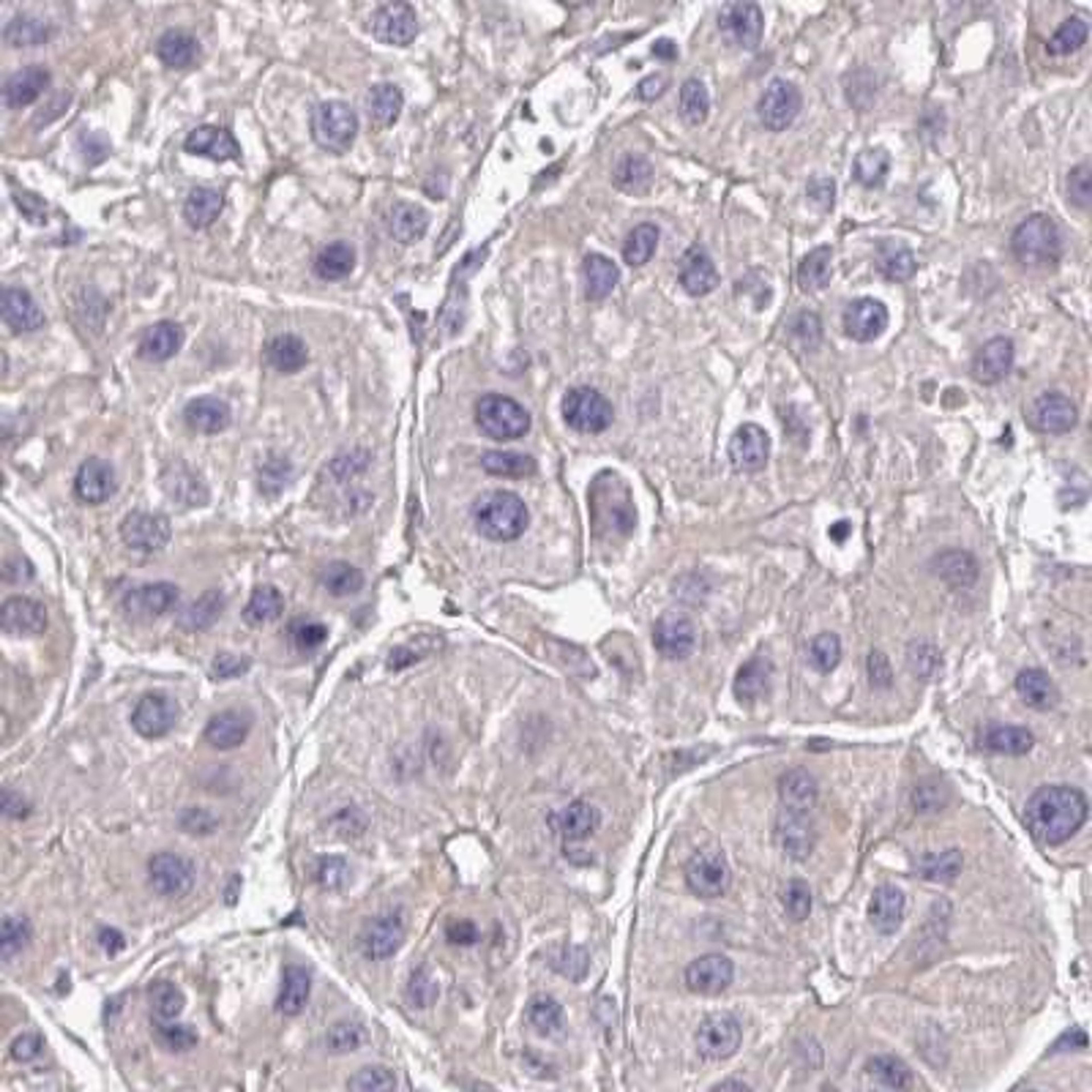 Immunohistochemistry: PRIMA1 Antibody [NBP2-32508] - liver cancer