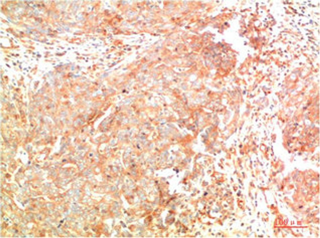 Immunohistochemical analysis of paraffin-embedded Human Breast Carcinoma Tissue using ATG7  Mouse mAb diluted at 1:200.