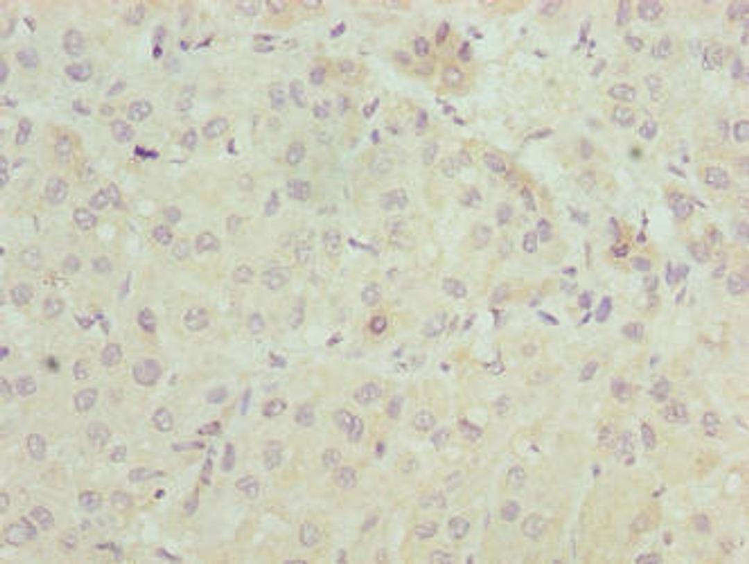 Immunohistochemistry of paraffin-embedded human liver cancer using CSB-PA889139LA01HU at dilution of 1:100