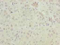 Immunohistochemistry of paraffin-embedded human liver cancer using CSB-PA889139LA01HU at dilution of 1:100