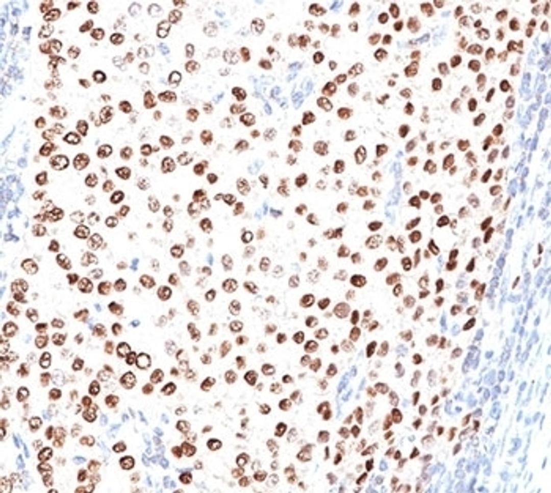 IHC testing of human breast carcinoma stained with progesterone receptor antibody (PR500).