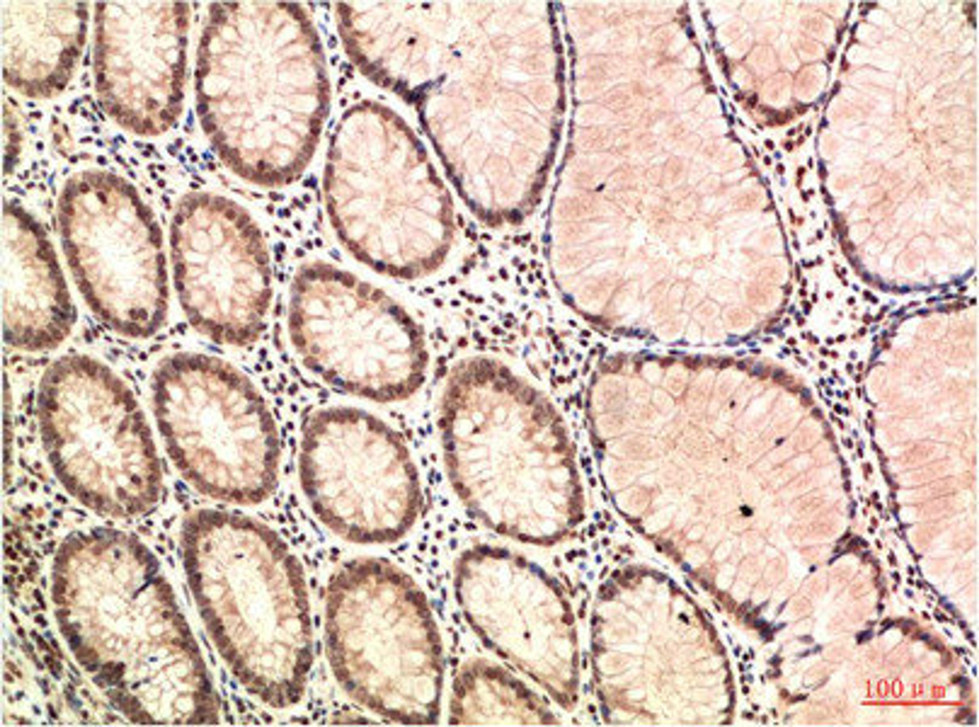 Immunohistochemical analysis of paraffin-embedded Human Colon Carcinoma Tissue using ATM Mouse mAb diluted at 1:200.