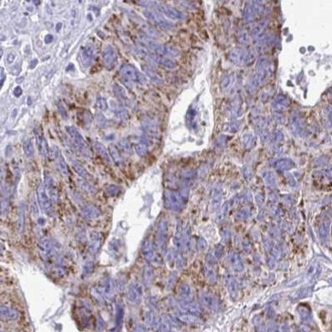 Immunohistochemistry: SAMD13 Antibody [NBP2-31734] - stomach cancer