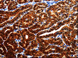 The image is immunohistochemistry of paraffin-embedded Human thyroid cancer tissue using CSB-PA937228(AK1 Antibody) at dilution 1/25. (Original magnification: ×200)