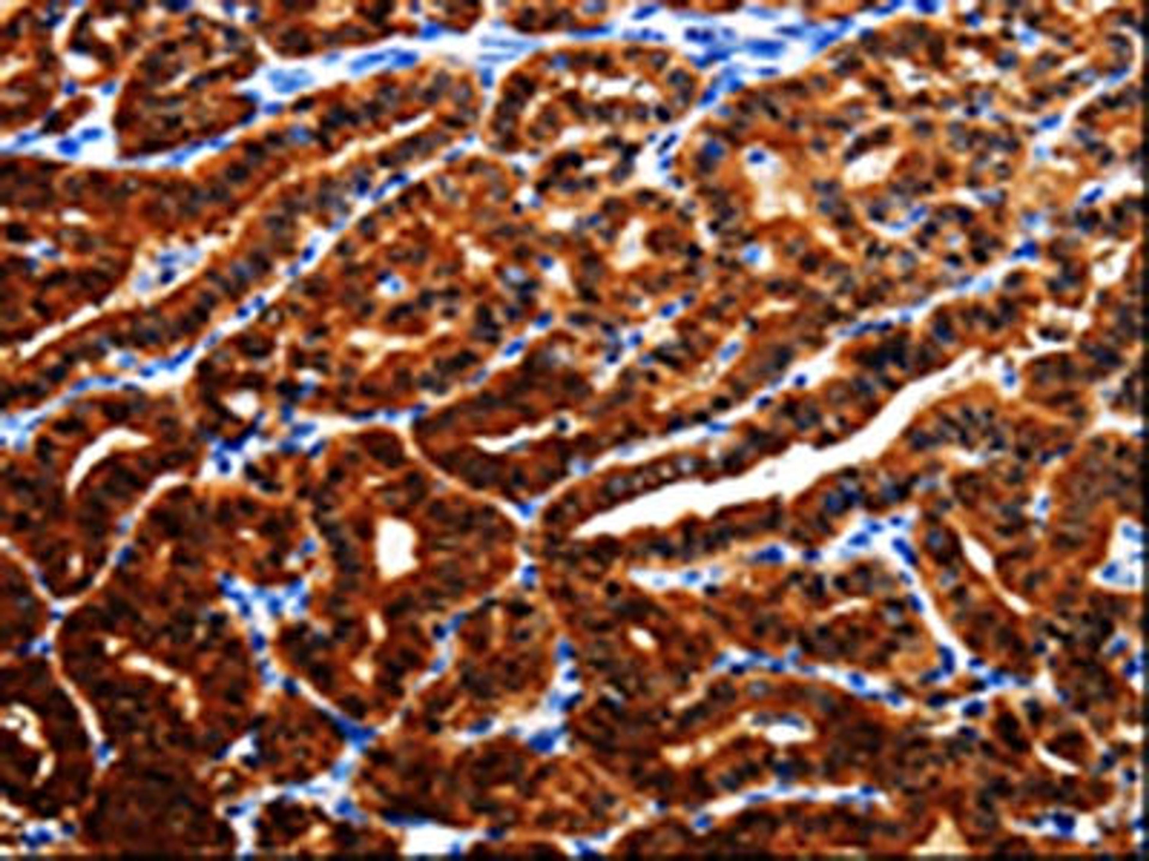 The image is immunohistochemistry of paraffin-embedded Human thyroid cancer tissue using CSB-PA937228(AK1 Antibody) at dilution 1/25. (Original magnification: ×200)