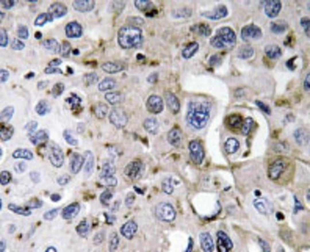 Immunohistochemistry-Paraffin: PDGFA Antibody [NBP1-19781] - Paraffin-embedded human lung carcinoma tissue.