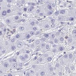 Immunohistochemistry: Myosin IF Antibody [NBP2-31598] - liver cancer