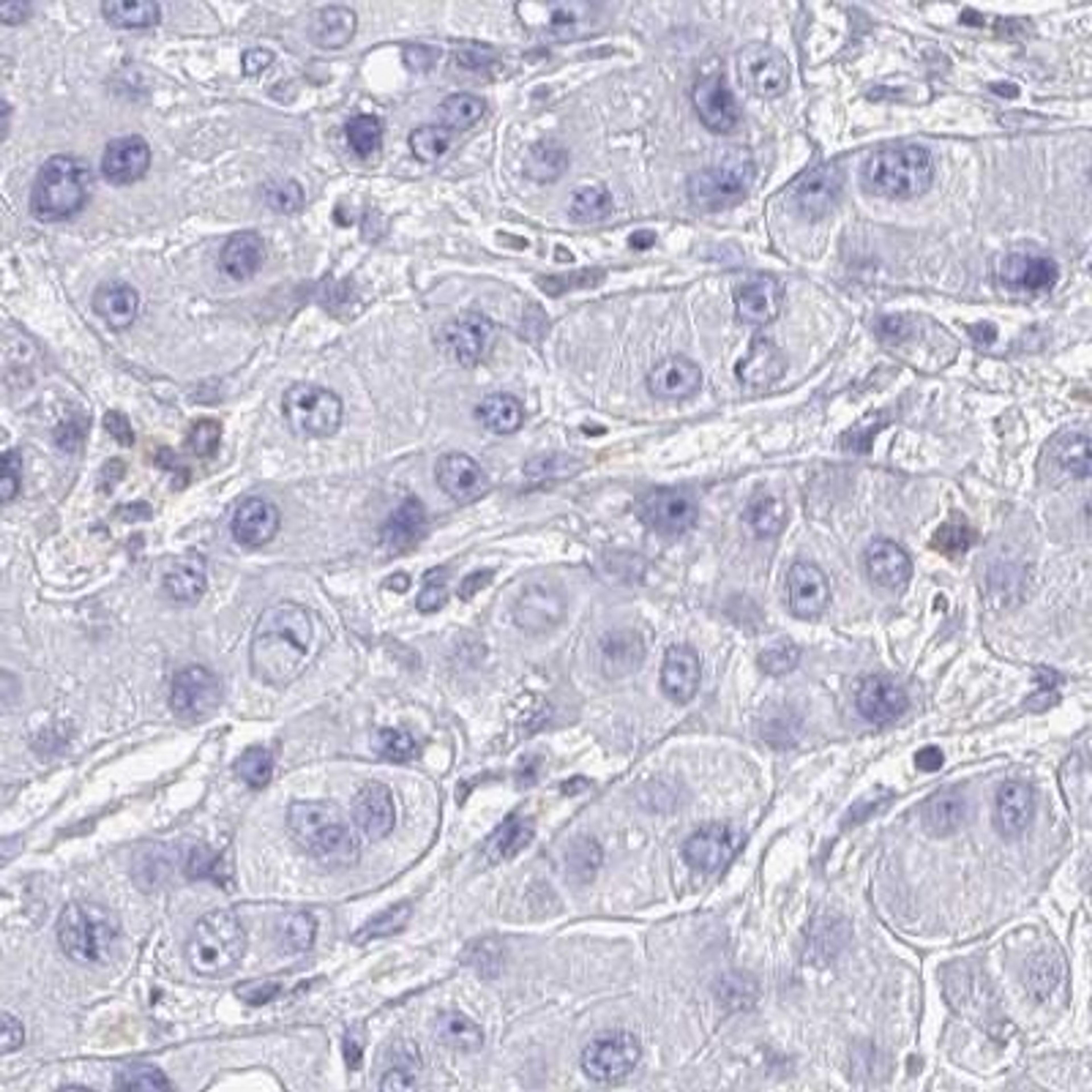 Immunohistochemistry: Myosin IF Antibody [NBP2-31598] - liver cancer