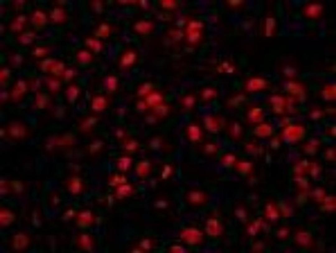 Immunocytochemistry/Immunofluorescence: CPSF1 Antibody [NB100-79822] - FFPE section of human breast carcinoma. Antibody: Affinity purified rabbit anti-CPSF160 used at a dilution of 1:100. Detection: Red-fluorescent goat anti-rabbit IgG highly cross-adsorbed Antibody Hilyte PlusTM 555 used at a dilution of 1:100.