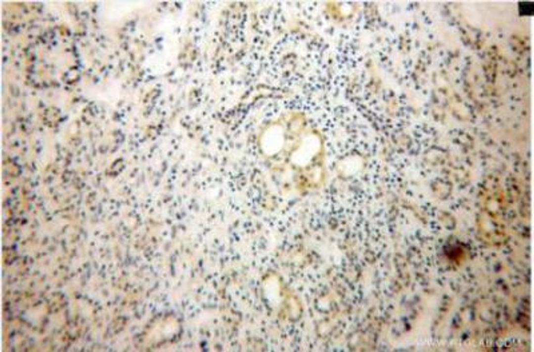 Immunohistochemistry-Paraffin: Dermatopontin Antibody [NB110-68135] - Immunohistochemistry of paraffin-embedded Pancreas cancer using (NB110-68135) at Dilution 1:100 (under 10x lens).