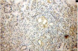 Immunohistochemistry-Paraffin: Dermatopontin Antibody [NB110-68135] - Immunohistochemistry of paraffin-embedded Pancreas cancer using (NB110-68135) at Dilution 1:100 (under 10x lens).