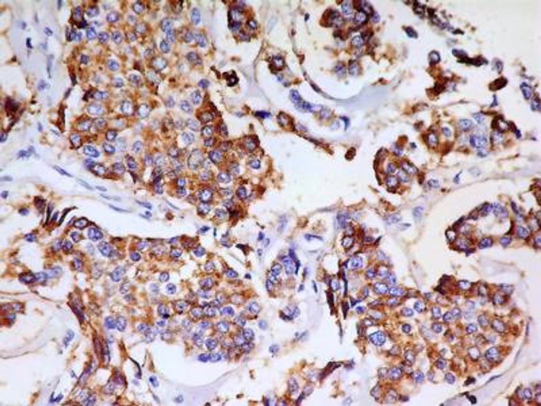 Immunohistochemistry-Paraffin: Cutaneous Lymphocyte Antigen (CLA) Antibody (HECA-452) [NB100-78039] - IHC analysis of formalin-fixed paraffin-embedded tissue section of human breast adenocarcinoma using CLA antibody (clone HECA-452) at 5 ug/ml concentration. The antibody generated a membrane-cytoplasmic staining in the cancerous cells of breast adenocarcinoma. Note:- Besides lymphocytes, CLA has been shown to be  present on cells of normal endometrium as well as breast cancer tissues (PMID 19625313 and 22970241).