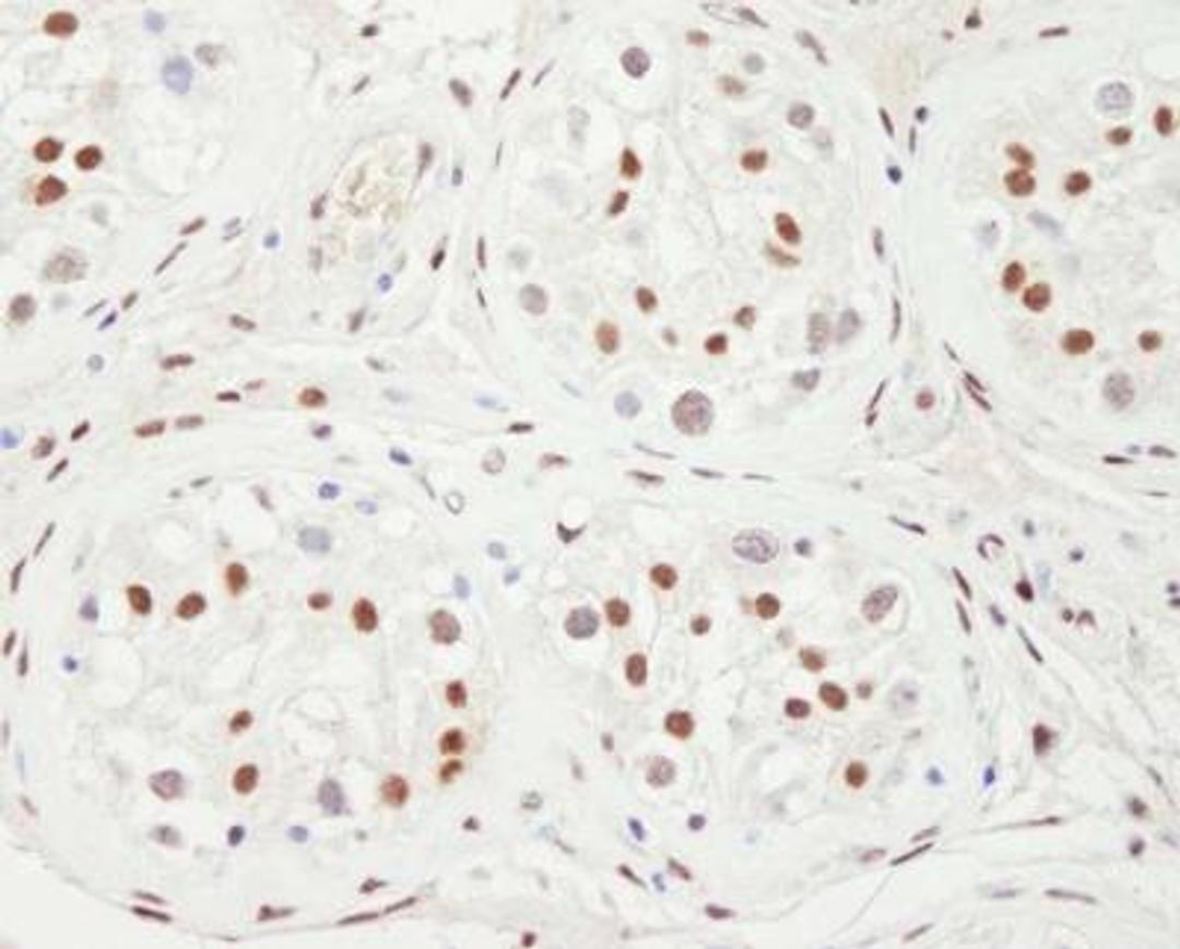 Immunohistochemistry-Paraffin: NCOA2 Antibody [NBP2-22162] - Sample: FFPE section of human testicular seminoma.  Antibody: Affinity purified rabbit anti-NCOA2 used at a dilution of 1:1,000 (1ug/ml). Detection: DAB