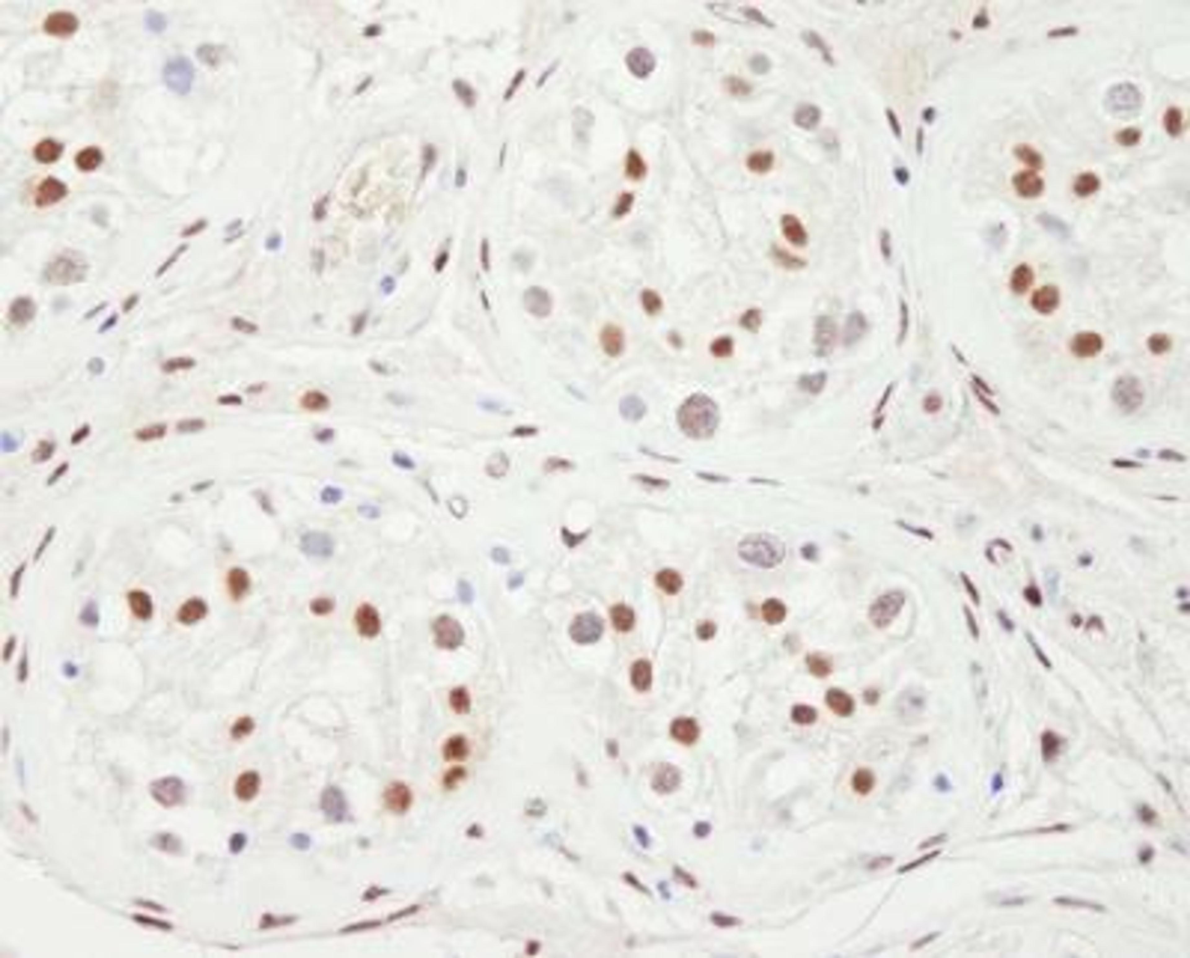 Immunohistochemistry-Paraffin: NCOA2 Antibody [NBP2-22162] - Sample: FFPE section of human testicular seminoma.  Antibody: Affinity purified rabbit anti-NCOA2 used at a dilution of 1:1,000 (1ug/ml). Detection: DAB