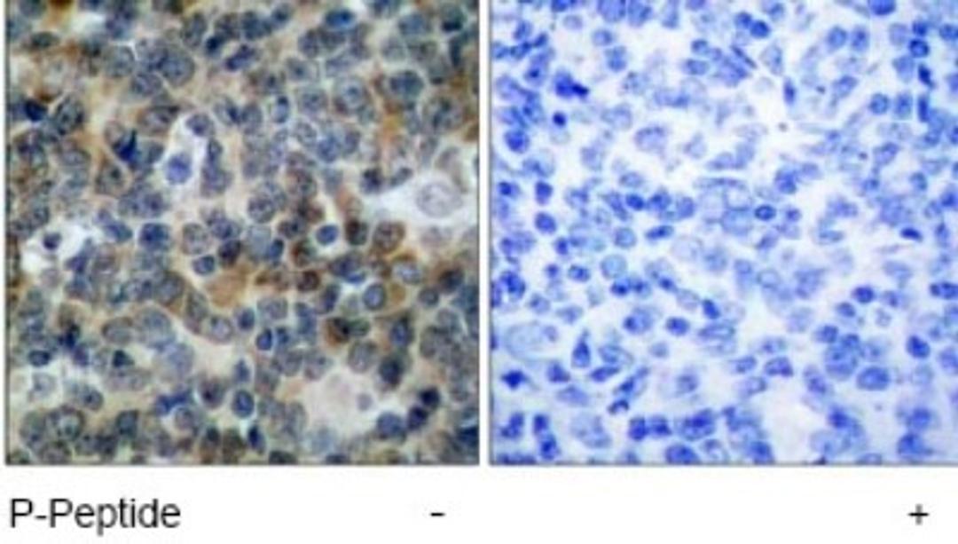 Immunohistochemistry: VASP [p Ser238] Antibody [NB100-82254] - Immunohistochemical analysis of paraffin-embedded human tonsil carcinoma tissue, using VASP (phospho-Ser238) antibody