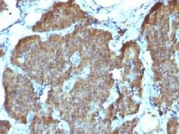 IHC testing of FFPE human pheochromocytoma with NSE antibody (clone SPM347). Required HIER: boil sections in 10mM citrate buffer, pH6, for 10-20 min.