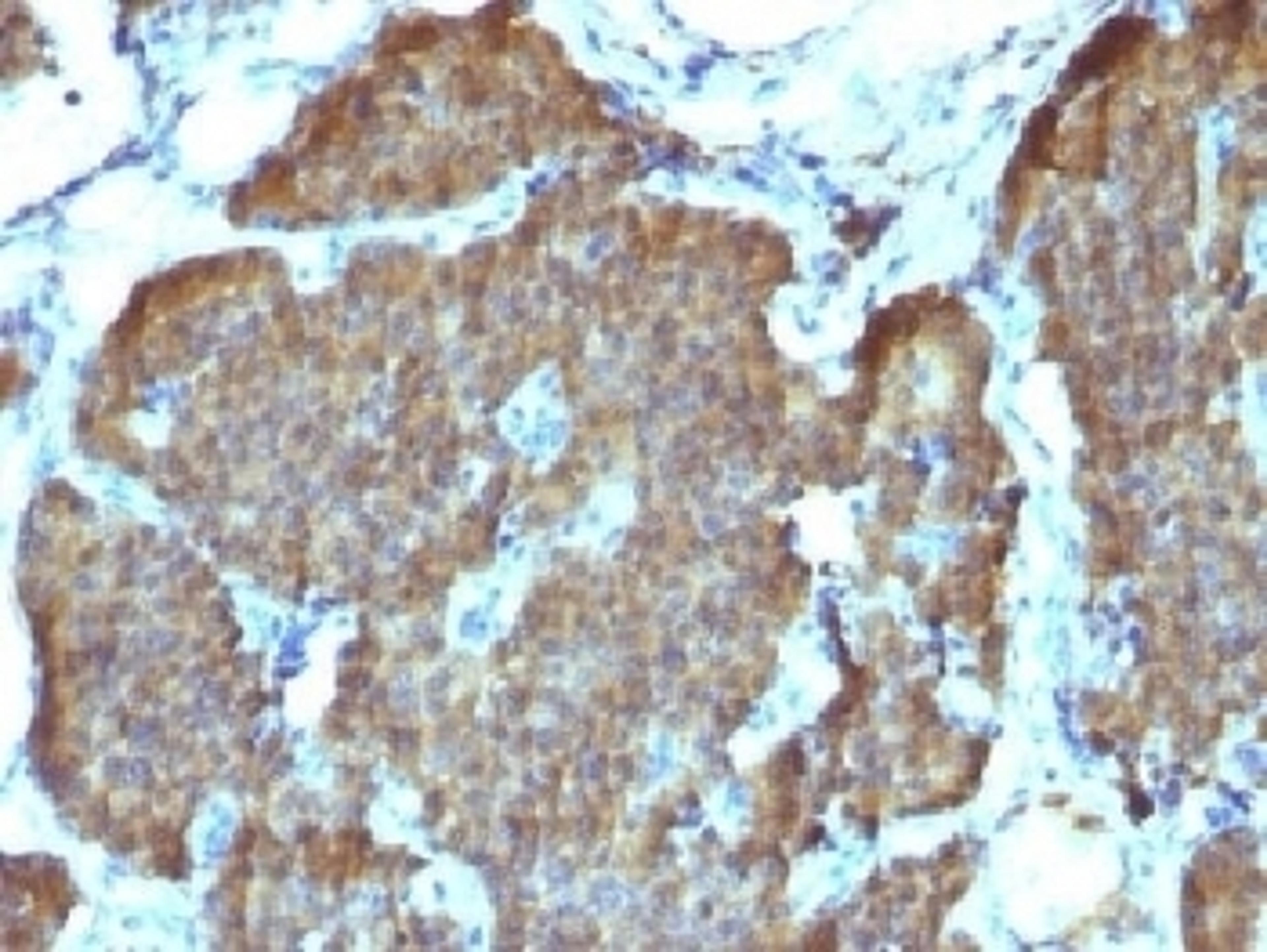 IHC testing of FFPE human pheochromocytoma with NSE antibody (clone SPM347). Required HIER: boil sections in 10mM citrate buffer, pH6, for 10-20 min.