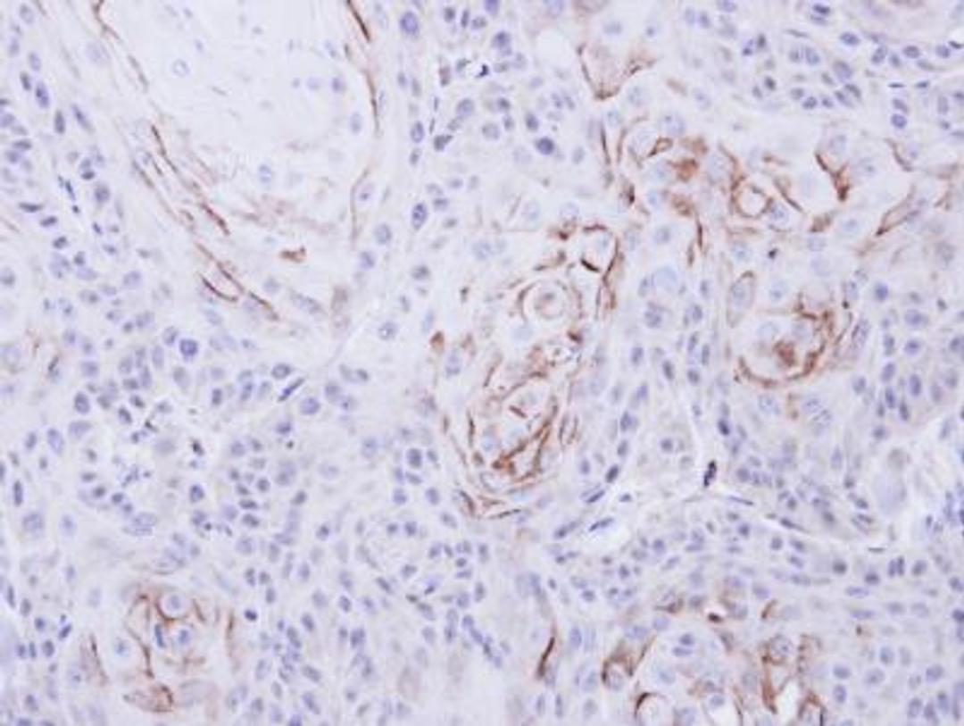 Immunohistochemistry-Paraffin: mu Opioid R/OPMR1 Antibody [NBP1-31180] - Paraffin-embedded Cal27 xenograft, using antibody at 1:500 dilution.