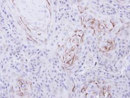 Immunohistochemistry-Paraffin: mu Opioid R/OPMR1 Antibody [NBP1-31180] - Paraffin-embedded Cal27 xenograft, using antibody at 1:500 dilution.