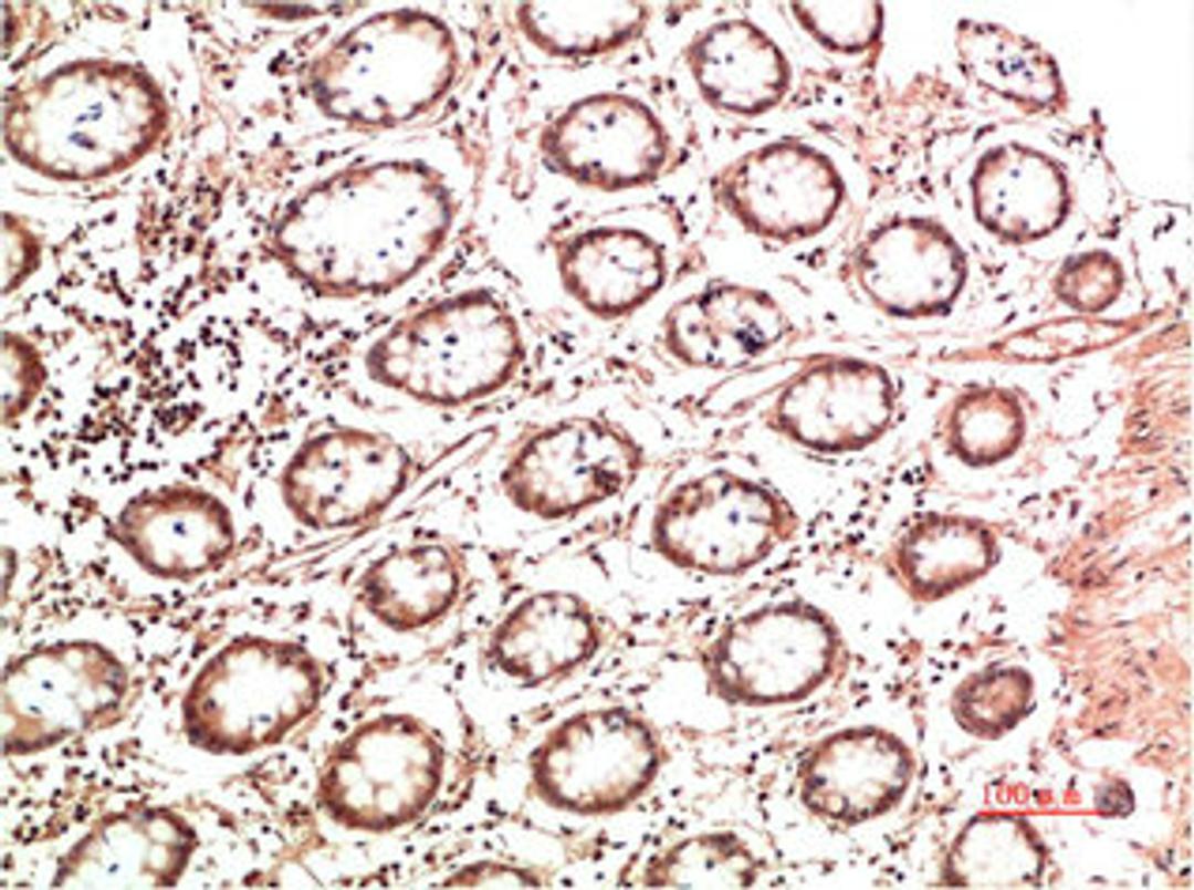 Immunohistochemical analysis of paraffin-embedded Human Colon Carcinoma Tissue using Collagen II Mouse mAb diluted at 1:500