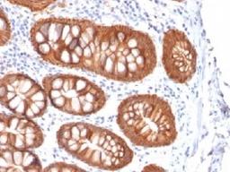 IHC testing of colon carcinoma with recombinant Ep-CAM antibody (clone rVU-1D9). Required HIER: boil tissue sections in 10mM citrate buffer, pH 6, for 10-20 min followed by cooling at RT for 20 min.