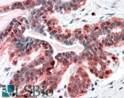 46-397 (3.8ug/ml) staining of paraffin embedded Human Breast Steamed antigen retrieval with citrate buffer pH 6, AP-staining.